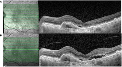 Initial experiences of switching to faricimab for neovascular age-related macular degeneration and polypoidal choroidal vasculopathy in an Asian population